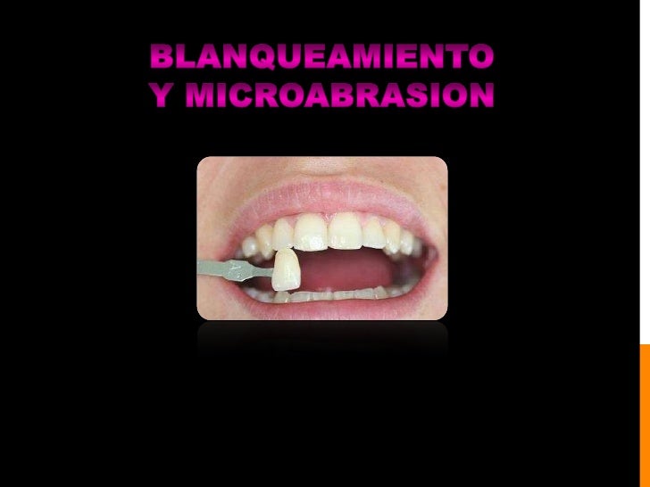 Blanqueamiento y microabrasion dental