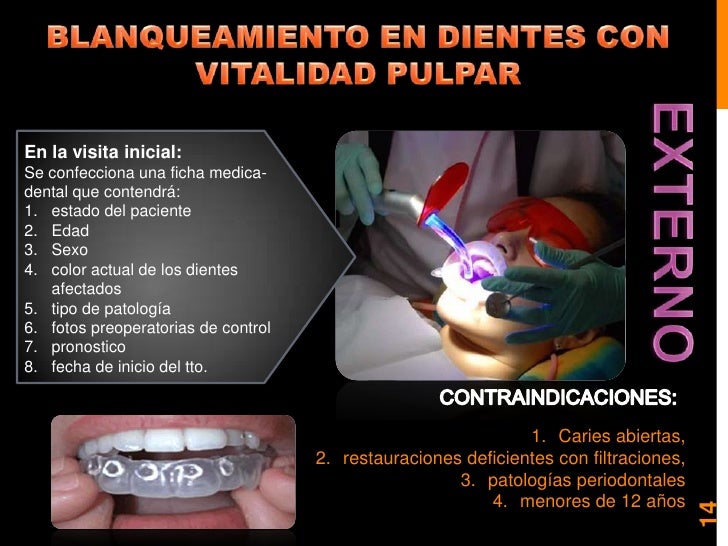 Blanqueamiento y microabrasion dental