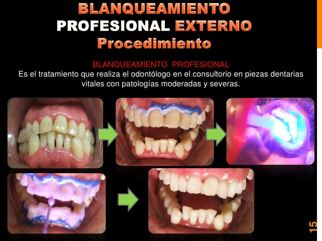 Blanqueamiento y microabrasion dental