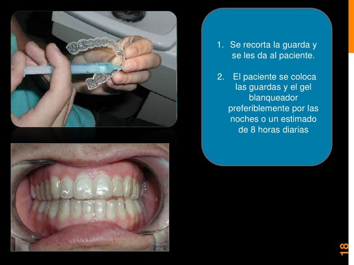 Blanqueamiento y microabrasion dental