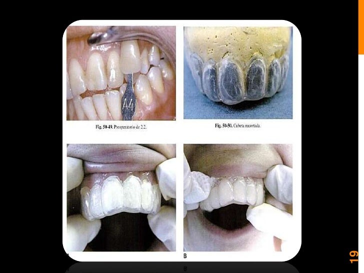 Blanqueamiento y microabrasion dental