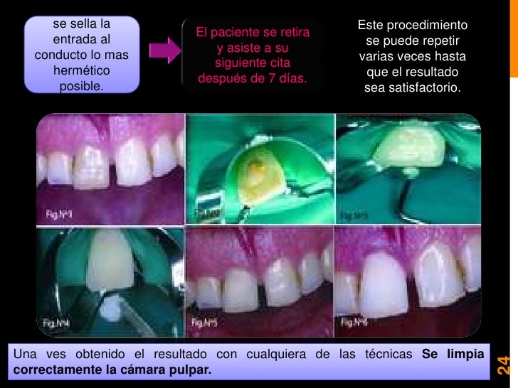 Blanqueamiento y microabrasion dental