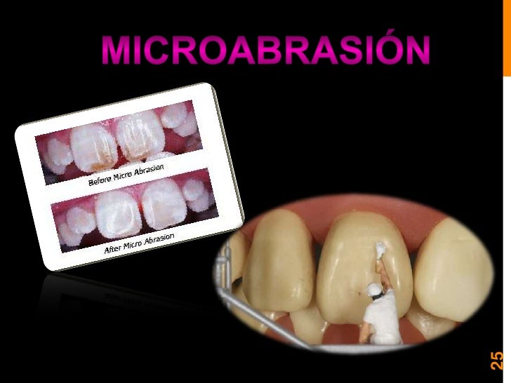 Blanqueamiento y microabrasion dental