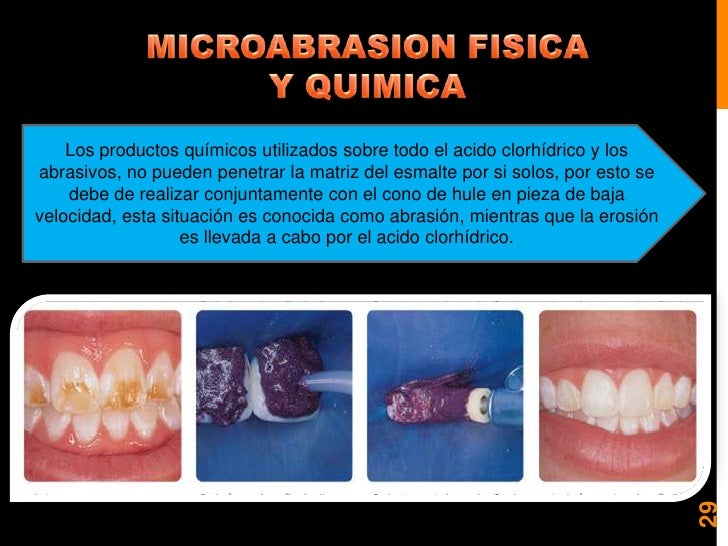 Blanqueamiento y microabrasion dental