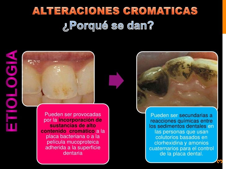 Blanqueamiento y microabrasion dental