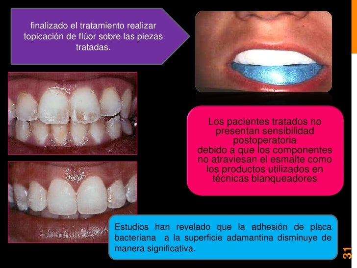 Blanqueamiento y microabrasion dental