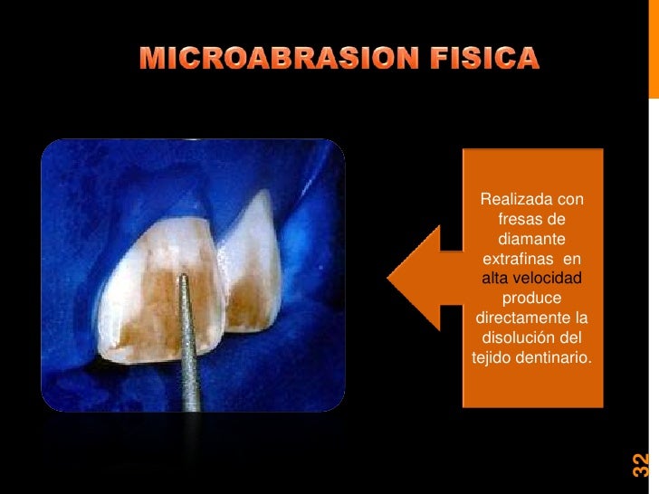 Blanqueamiento y microabrasion dental