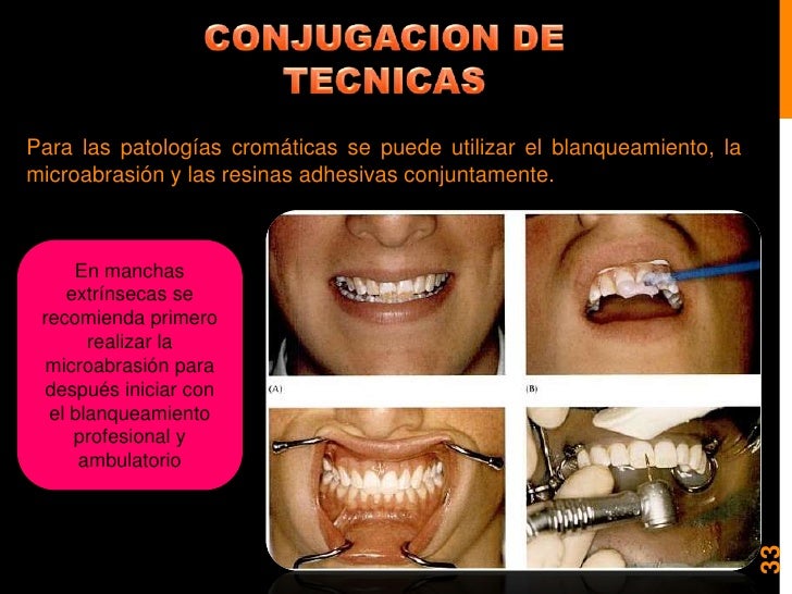 Blanqueamiento y microabrasion dental