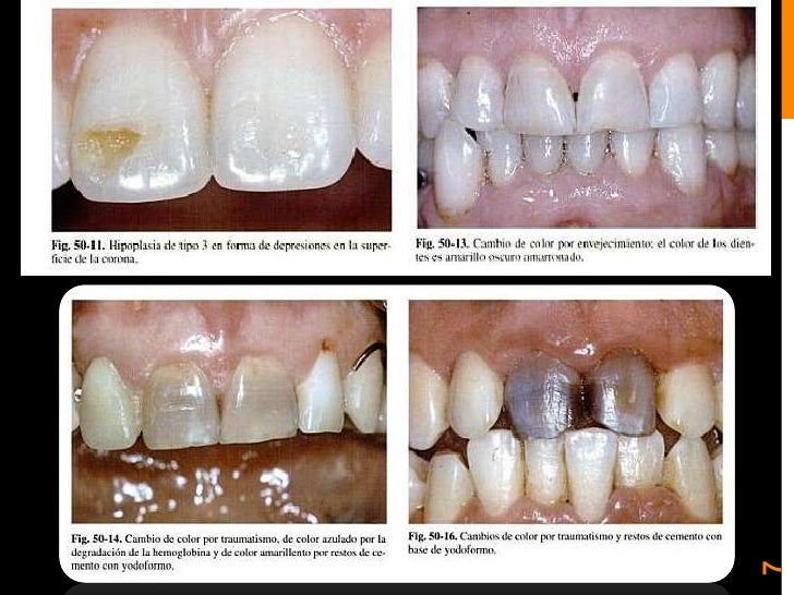 Blanqueamiento y microabrasion dental