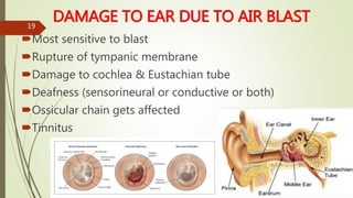DAMAGE TO EAR DUE TO AIR BLAST
Most sensitive to blast
Rupture of tympanic membrane
Damage to cochlea & Eustachian tube
Deafness (sensorineural or conductive or both)
Ossicular chain gets affected
Tinnitus
19
 