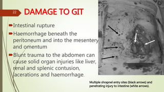 DAMAGE TO GIT
Intestinal rupture
Haemorrhage beneath the
peritoneum and into the mesentery
and omentum
Blunt trauma to the abdomen can
cause solid organ injuries like liver,
renal and splenic contusion,
lacerations and haemorrhage.
22
Multiple shrapnel entry sites (black arrows) and
penetrating injury to intestine (white arrows).
 