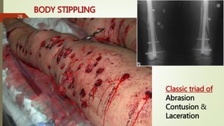 BODY STIPPLING
Classic triad of
Abrasion
Contusion &
Laceration
28
 