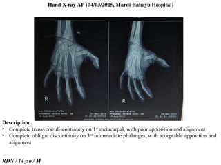 Trauma ledakan mercon / blast injury .pptx