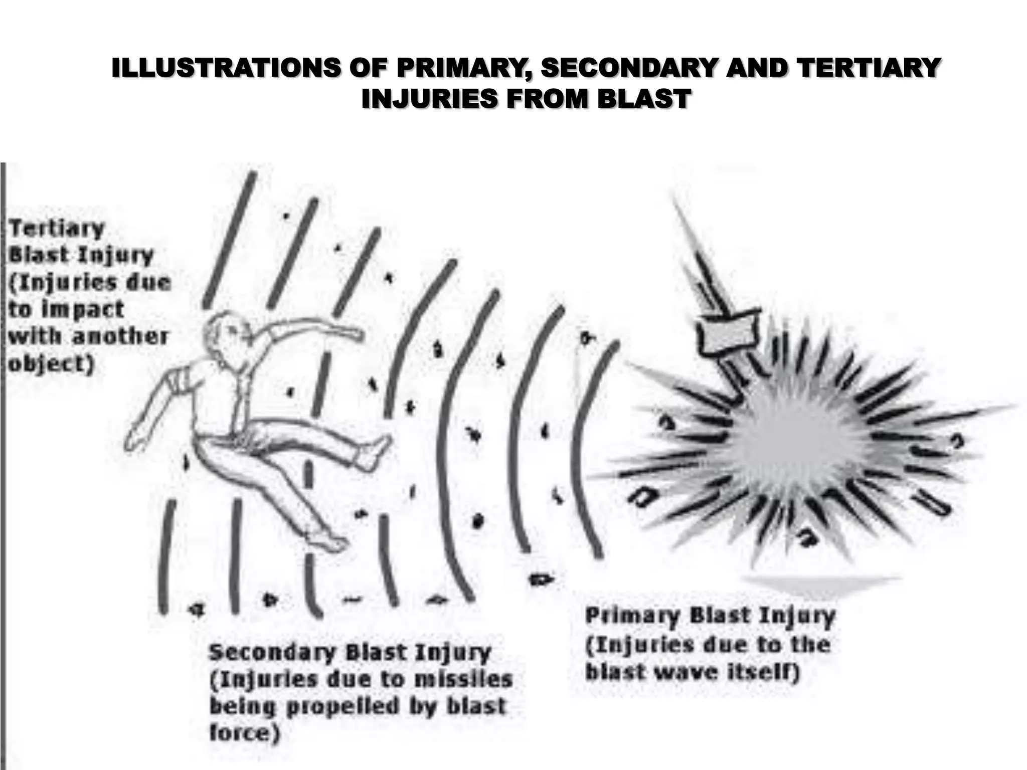 ILLUSTRATIONS OF PRIMARY, SECONDARY AND TERTIARY
INJURIES FROM BLAST
 