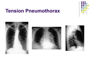 Tension Pneumothorax
 