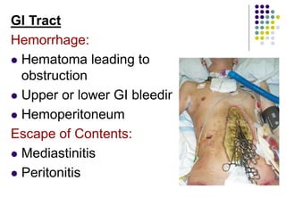 GI Tract
Hemorrhage:
 Hematoma leading to
obstruction
 Upper or lower GI bleeding
 Hemoperitoneum
Escape of Contents:
 Mediastinitis
 Peritonitis
 