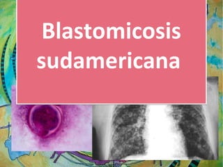 Blastomicosis
sudamericana

 