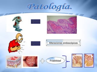 Alteraciones endoscópicas Friabilidad Patología. 