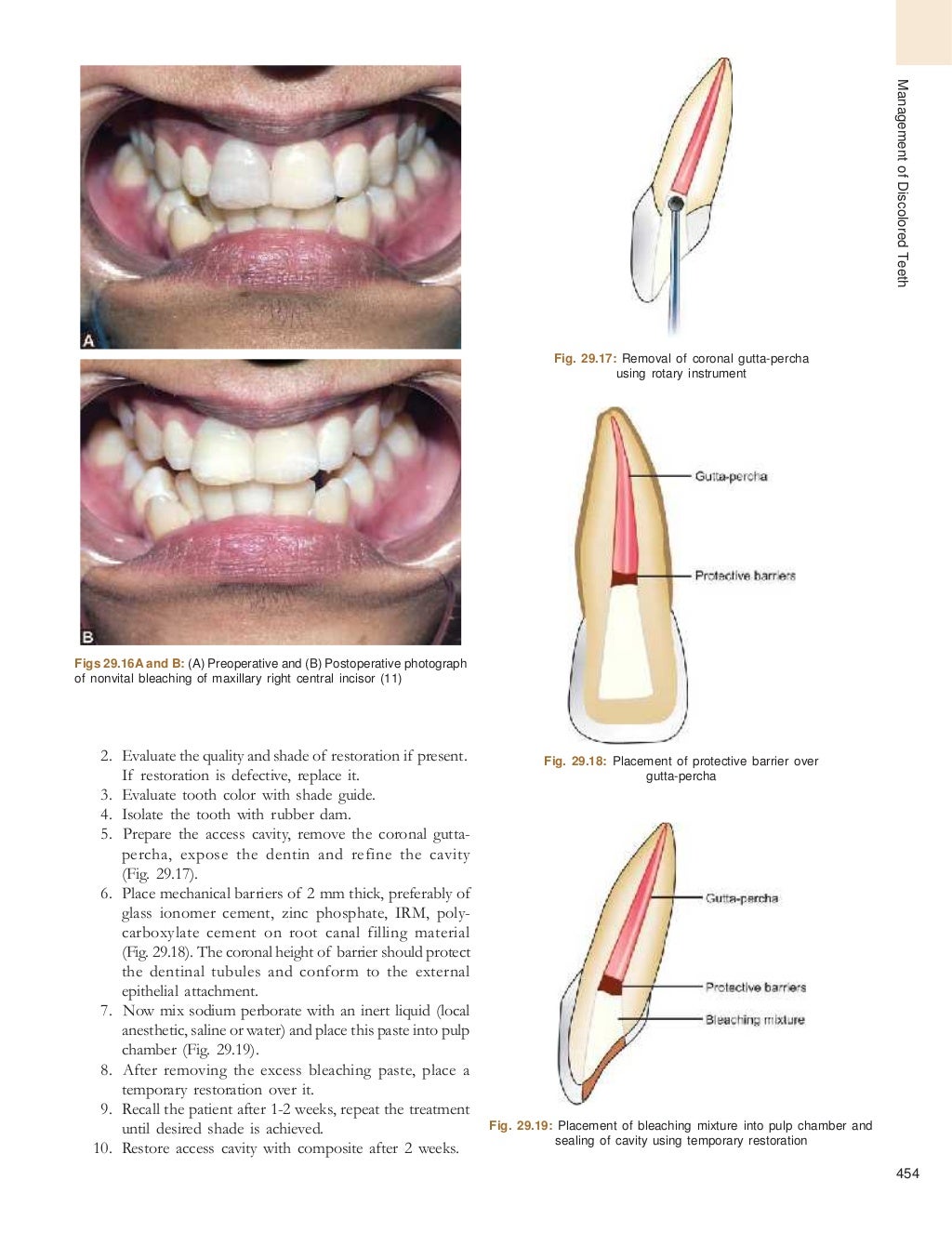 Bleaching of tooth endodontics best pdf