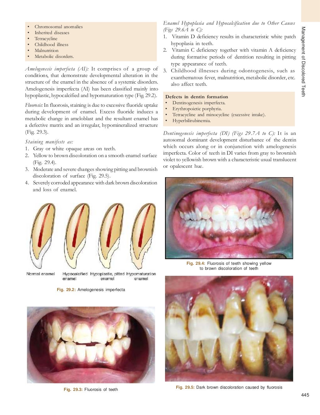 Bleaching of tooth endodontics best pdf