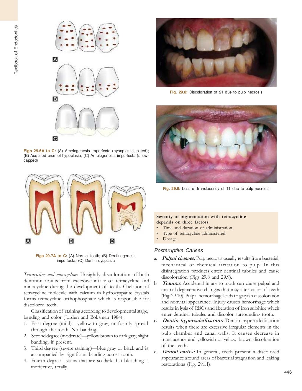 Bleaching of tooth endodontics best pdf