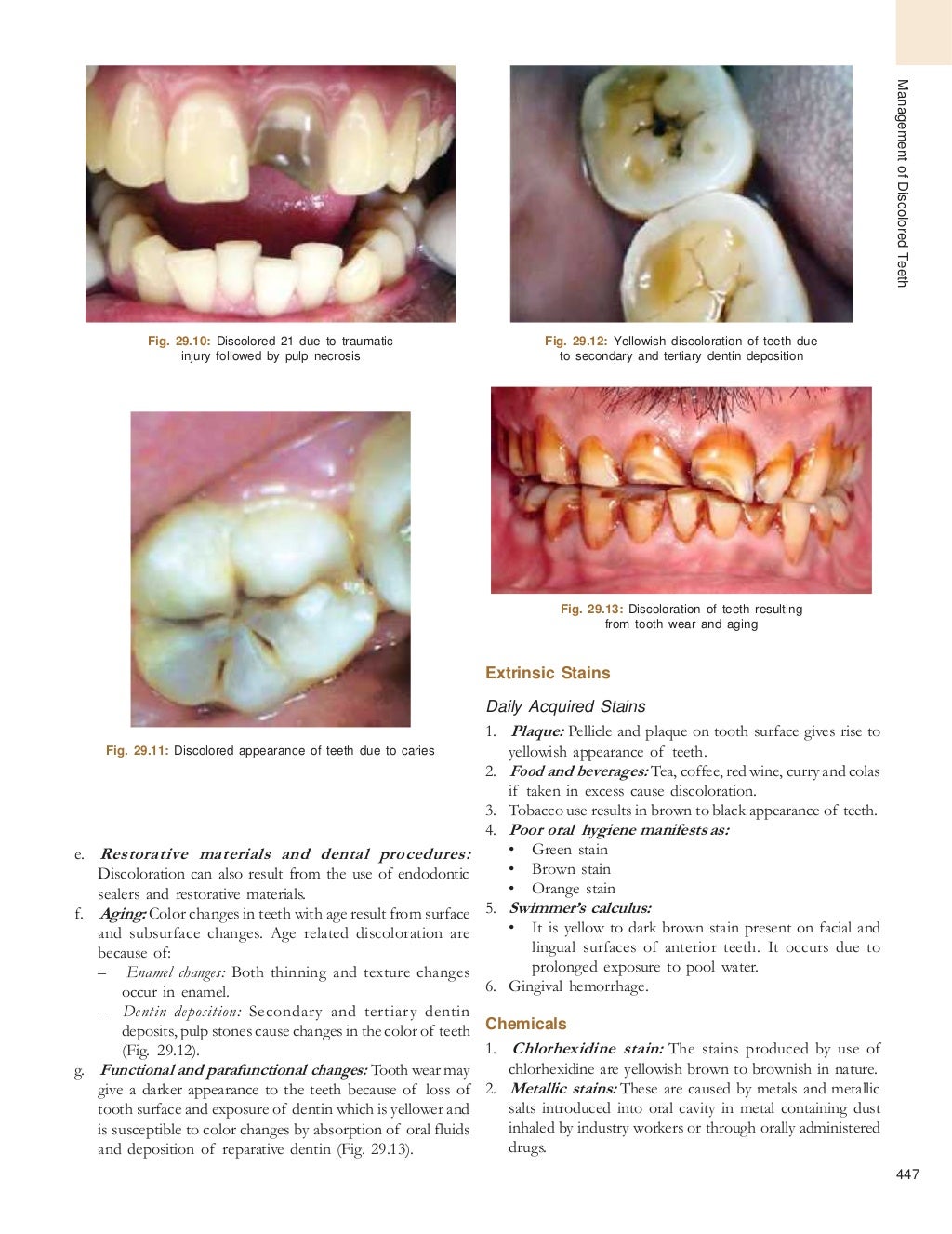 Bleaching of tooth endodontics best pdf