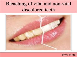 Bleaching of vital and non-vital
discolored teeth
Priya Mittal
 