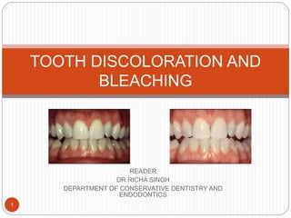 READER
DR RICHA SINGH
DEPARTMENT OF CONSERVATIVE DENTISTRY AND
ENDODONTICS
1
TOOTH DISCOLORATION AND
BLEACHING
 