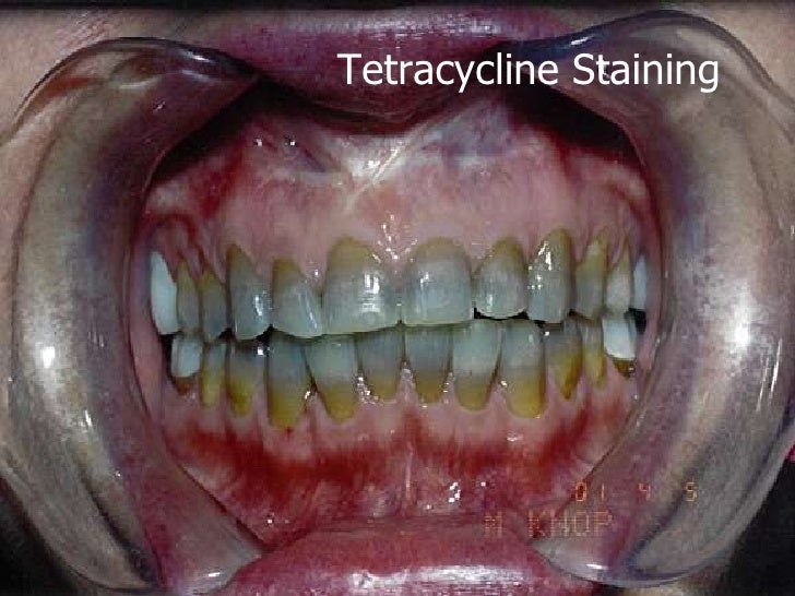 Tetracycline Stained Teeth Wiki