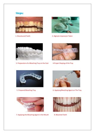 Steps:
1. Discoloured Teeth 2. Alginate impression Taken
3. Preparation of a Bleaching Tray on the Cast 4.Proper Shaping of the Tray
5. Prepared Bleaching Tray 6. Applying Bleaching Agent on The Tray
7. Applying the Bleaching Agent in the Mouth 8. Bleached Teeth
 