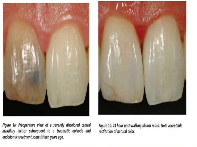 After effects of laser teeth whitening