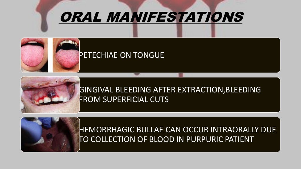 dental management of Bleeding disorders