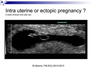 Dr.Basma ,FM,SCU,2012-2013
Intra uterine or ectopic pregnancy ?
5 week embryo and yolk sac
 