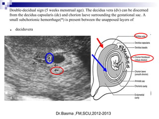 Dr.Basma ,FM,SCU,2012-2013
Double-decidual sign (5 weeks menstrual age). The decidua vera (dv) can be discerned
from the decidua capsularis (dc) and chorion laeve surrounding the gestational sac. A
small subchorionic hemorrhage(*) is present between the unapposed layers of
deciduvera.
 