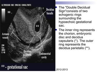 Dr.Basma ,FM,SCU,2012-2013
 The "Double Decidual
Sign"consists of two
echogenic rings
surrounding the
hypoechoic gestational
sac.
 The inner ring represents
the chorion, embryonic
disc and decidua
capsularis (*). The outer
ring represents the
decidua parietalis (**).
 