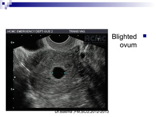 Dr.Basma ,FM,SCU,2012-2013
Blighted
ovum
 