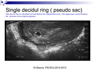 Dr.Basma ,FM,SCU,2012-2013
Single decidul ring ( pseudo sac)
This may be due to a decidual cast and fluid in the endometrial cavity. This appearance can be found in
the presence of an ectopic pregnancy
 