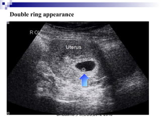 Dr.Basma ,FM,SCU,2012-2013
Double ring appearance
 