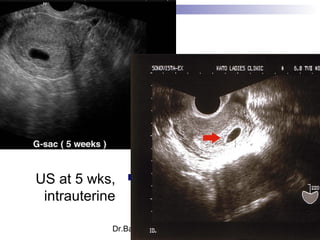 Dr.Basma ,FM,SCU,2012-2013
US at 5 wks,
intrauterine
 