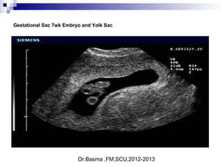 Dr.Basma ,FM,SCU,2012-2013
Gestational Sac 7wk Embryo and Yolk Sac
 