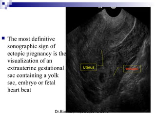 Dr.Basma ,FM,SCU,2012-2013
 The most definitive
sonographic sign of
ectopic pregnancy is the
visualization of an
extrauterine gestational
sac containing a yolk
sac, embryo or fetal
heart beat
ectopicUterus
 