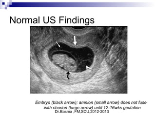 Dr.Basma ,FM,SCU,2012-2013
Normal US Findings
Embryo (black arrow); amnion (small arrow) does not fuse
with chorion (large arrow) until 12-16wks gestation.
 