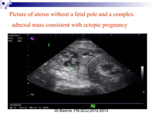Dr.Basma ,FM,SCU,2012-2013
Picture of uterus without a fetal pole and a complex
adnexal mass consistent with ectopic pregnancy
 