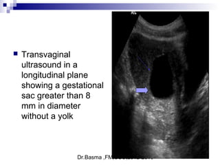 Dr.Basma ,FM,SCU,2012-2013
 Transvaginal
ultrasound in a
longitudinal plane
showing a gestational
sac greater than 8
mm in diameter
without a yolk
 