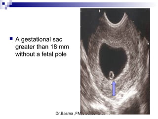 Dr.Basma ,FM,SCU,2012-2013
 A gestational sac
greater than 18 mm
without a fetal pole
 