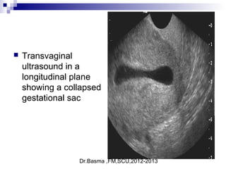 Dr.Basma ,FM,SCU,2012-2013
 Transvaginal
ultrasound in a
longitudinal plane
showing a collapsed
gestational sac
 