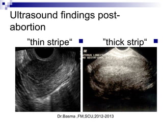 Dr.Basma ,FM,SCU,2012-2013
Ultrasound findings post-
abortion
“thin stripe” “thick strip”
 