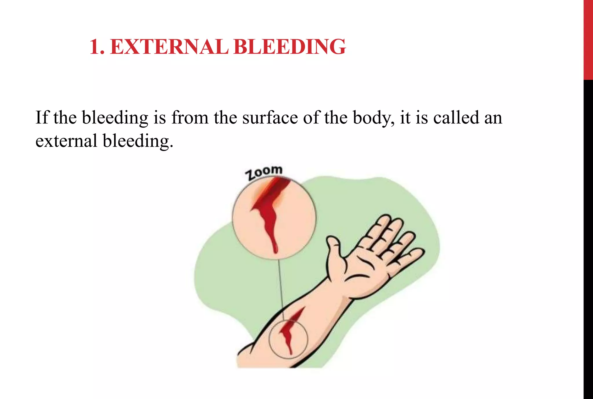 1. EXTERNAL BLEEDING
If the bleeding is from the surface of the body, it is called an
external bleeding.
 