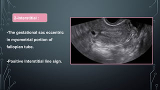 Radiological tips and tricks of Vaginal and uterine bleeding 3-1.pptx