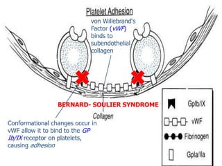 von Willebrand‘s
Factor (vWF)
binds to
subendothelial
collagen.
Conformational changes occur in
vWF allow it to bind to the GP
Ib/IX receptor on platelets,
causing adhesion
BERNARD- SOULIER SYNDROME
 
